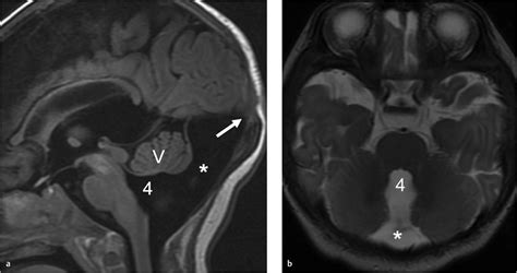 mega cisterna magna radiology